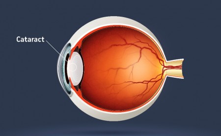 Grauer Star Zeichnung