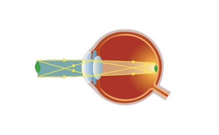 Visualisierung einer Hornhautverkrümmung