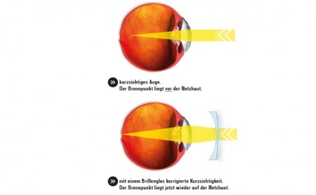 Visualisierung von Kurzsichtigkeit