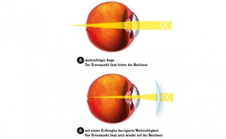 Visualisierung von Weitsichtigkeit